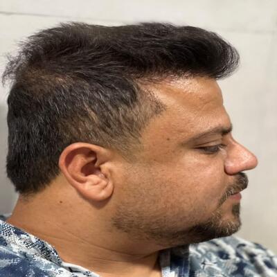 After hair transplant example