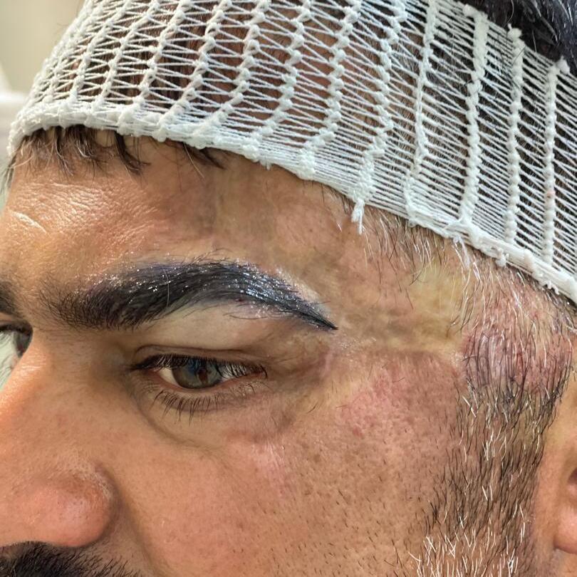 After photo of scar revisiontransplant