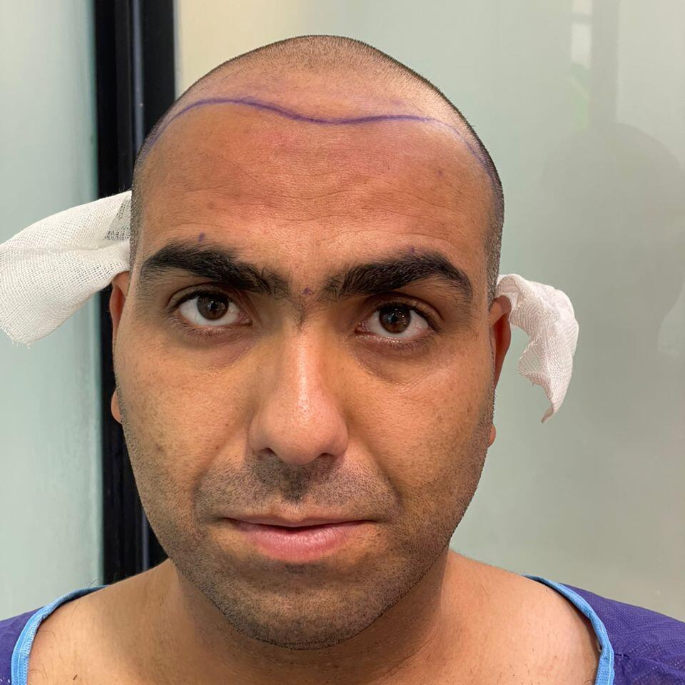 Before hair transplant example