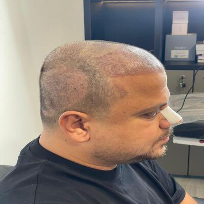 Before hair transplant example
