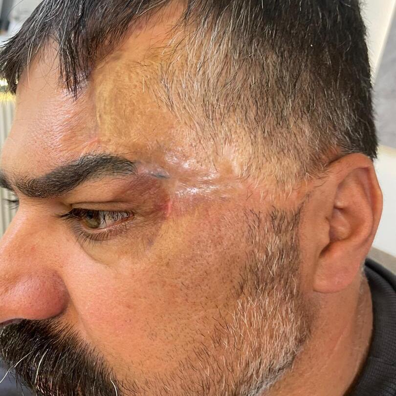 Before photo of scar camouflage tattooing