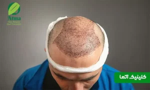 آیا کاشت مو طبیعی است