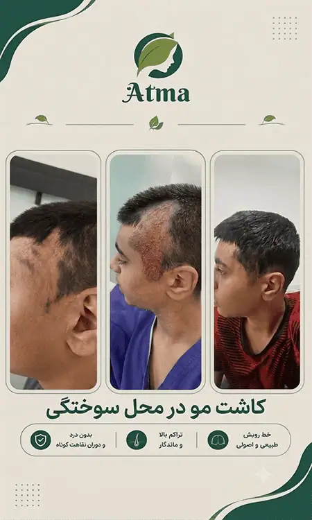 کاشت محل سوختگی در کلینیک آتما