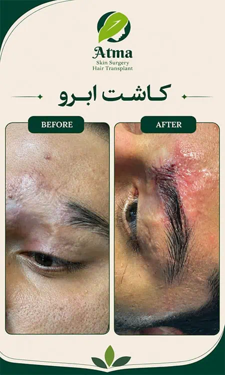 کاشت ابرو در جای زخم