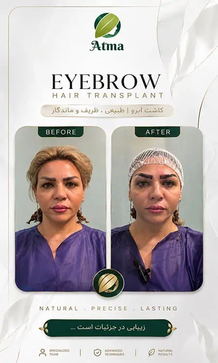 کاشت ابرو با خط رویش طبیعی