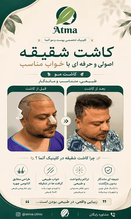 کاشت مو و شقیقه در کلینیک آتما