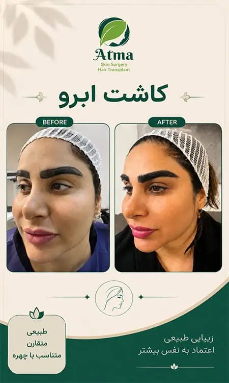 کاشت ابرو پرتراکم