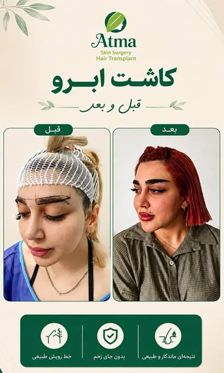 کاشت ابرو ظبیعی در کلینیک اتما