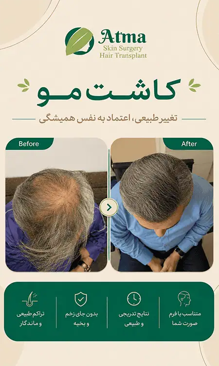 کاشت مو طبیعی در کلینیک آتما