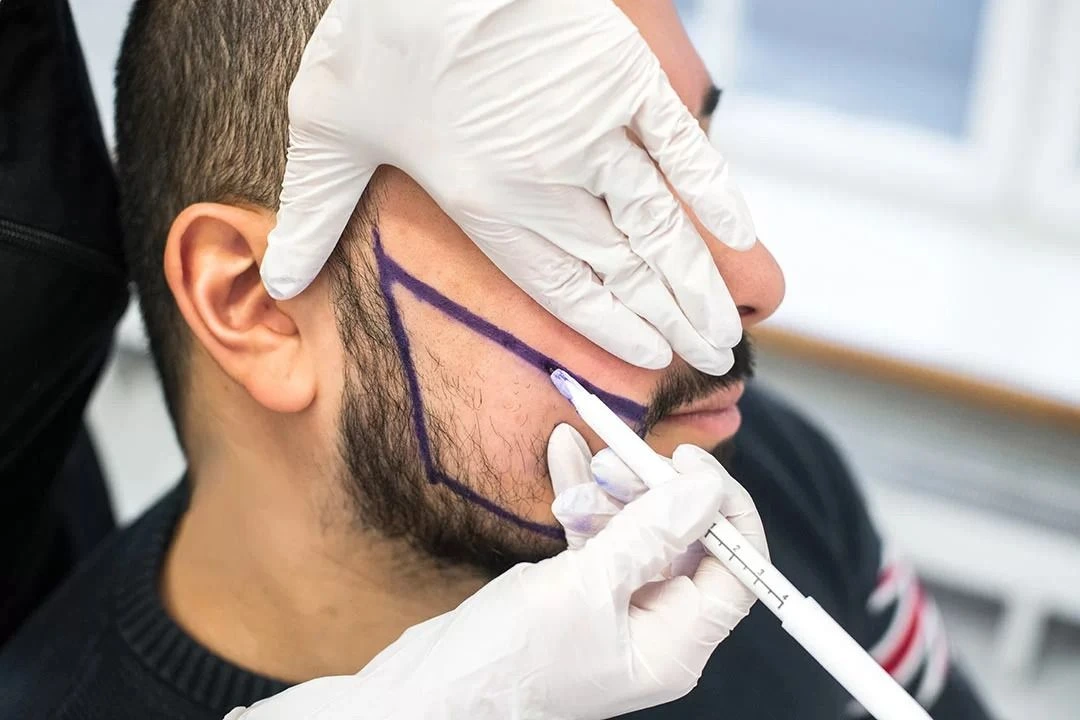 کاشت ریش و سبیل در شیراز