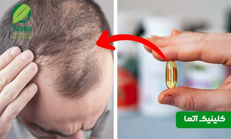 ریزش مو به دلیل کمبود ویتامین
