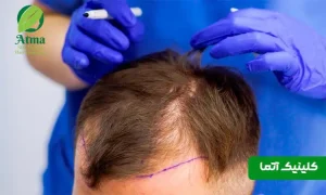مراقبت های بعد از کاشت مو از روز اول تا ۶ ماه