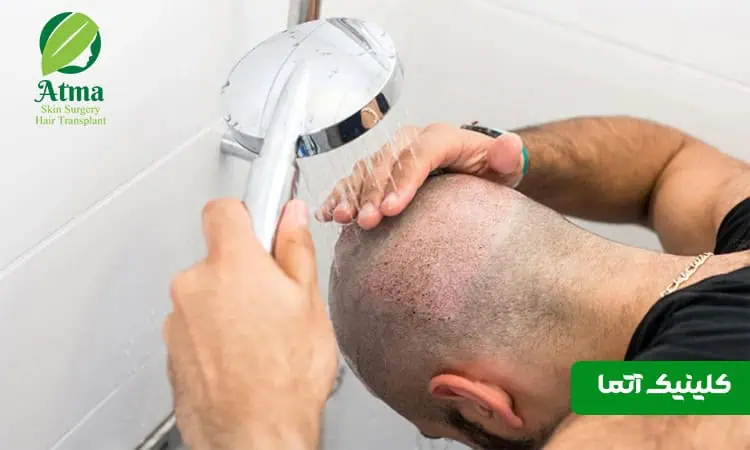 شستشوی صحیح موها بعد از کاشت مو