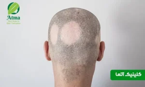 آیا ریزش موی سکه‌ای خطرناک است