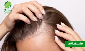 ۵ علت ریزش مو در زنان بالای ۴۰ سال