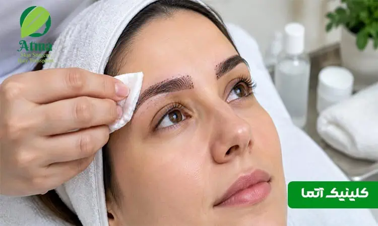 مراقبت های بعد از کاشت ابرو