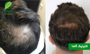 علت ریزش موی وسط سر در مردان