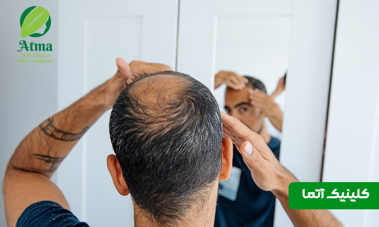 کوچک شدن فولیکول مو در اثر هورمون DHT در ریزش موی وسط سر مردان